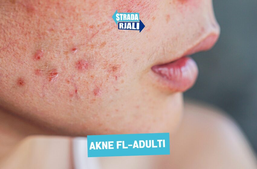  Akne fl-adulti